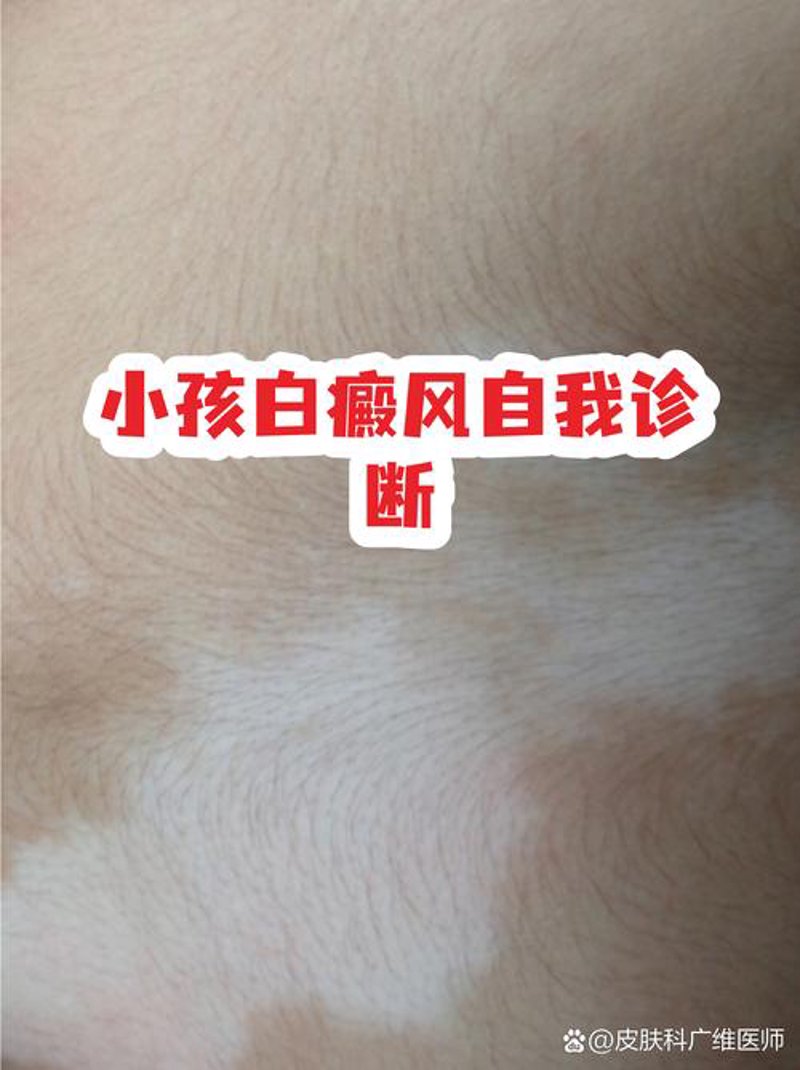 白癜风诊断