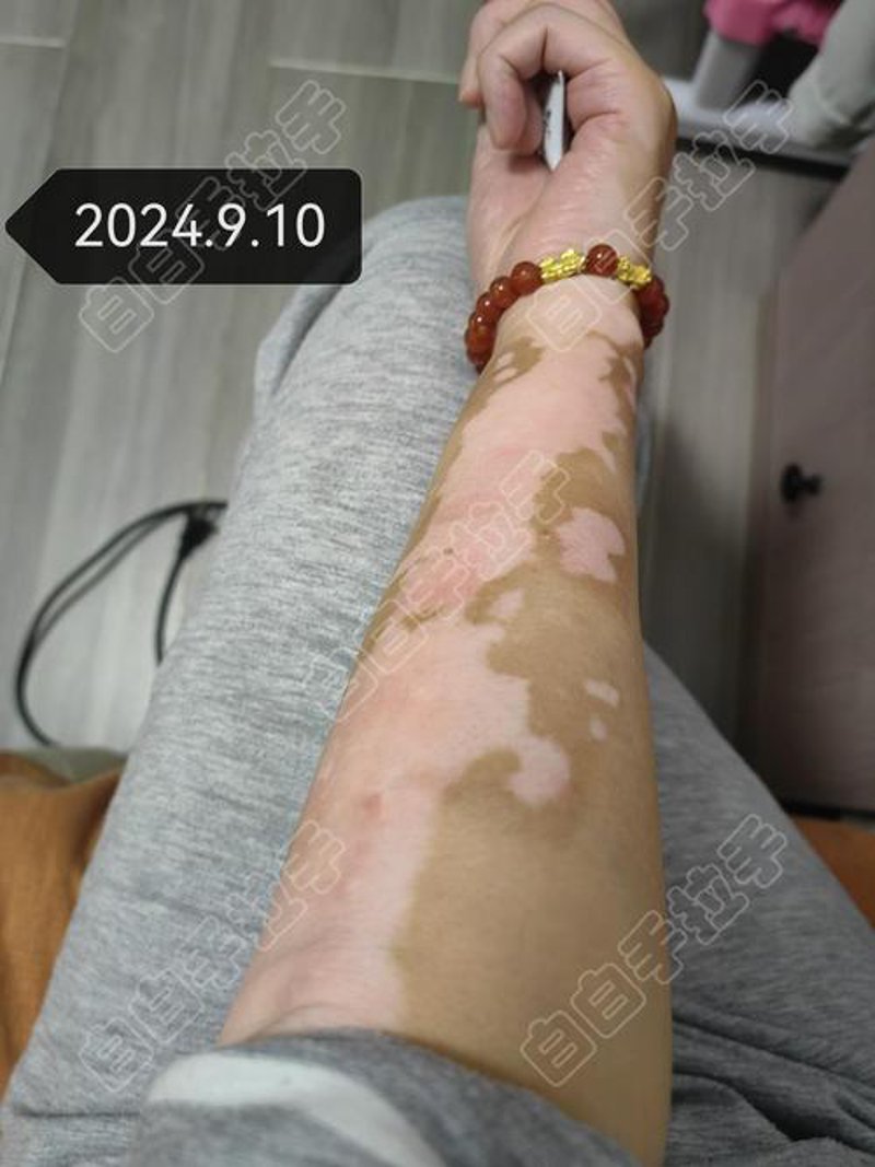 白斑病治疗