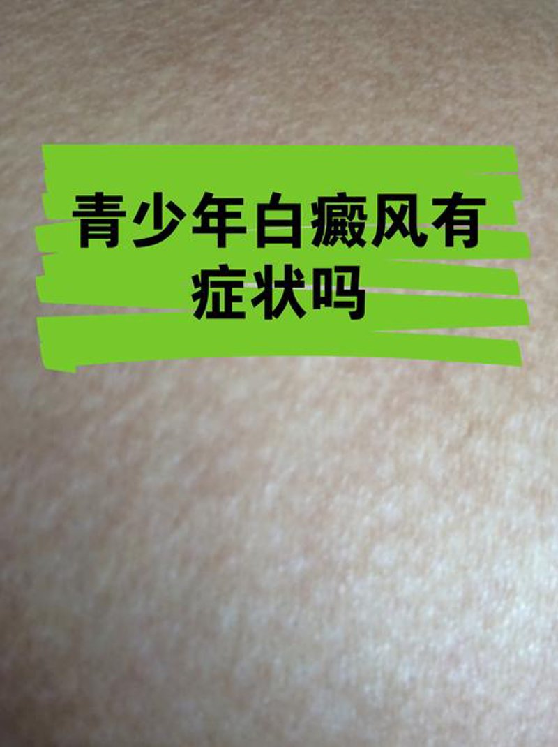 白癜风治疗