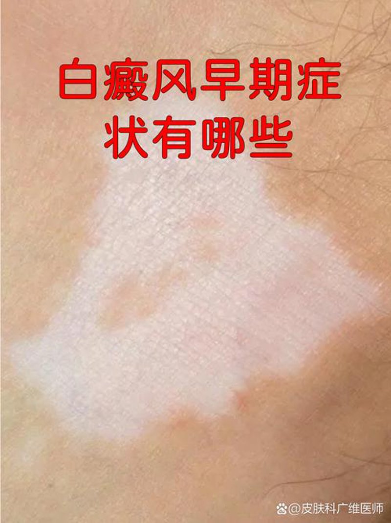 白癜风早期症状