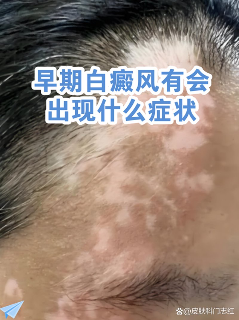 白癜风治疗案例分析:寻找生活的那束光