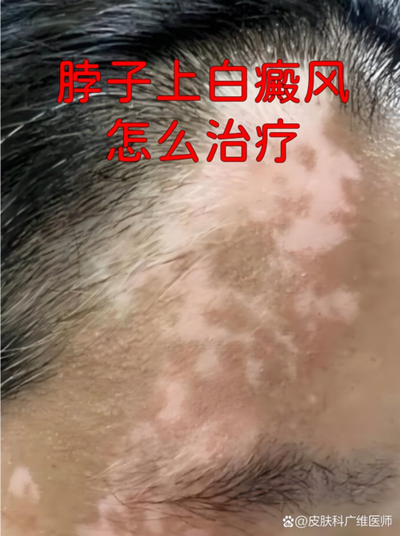 白癜风患儿的治疗曙光:如何选择专业医院?