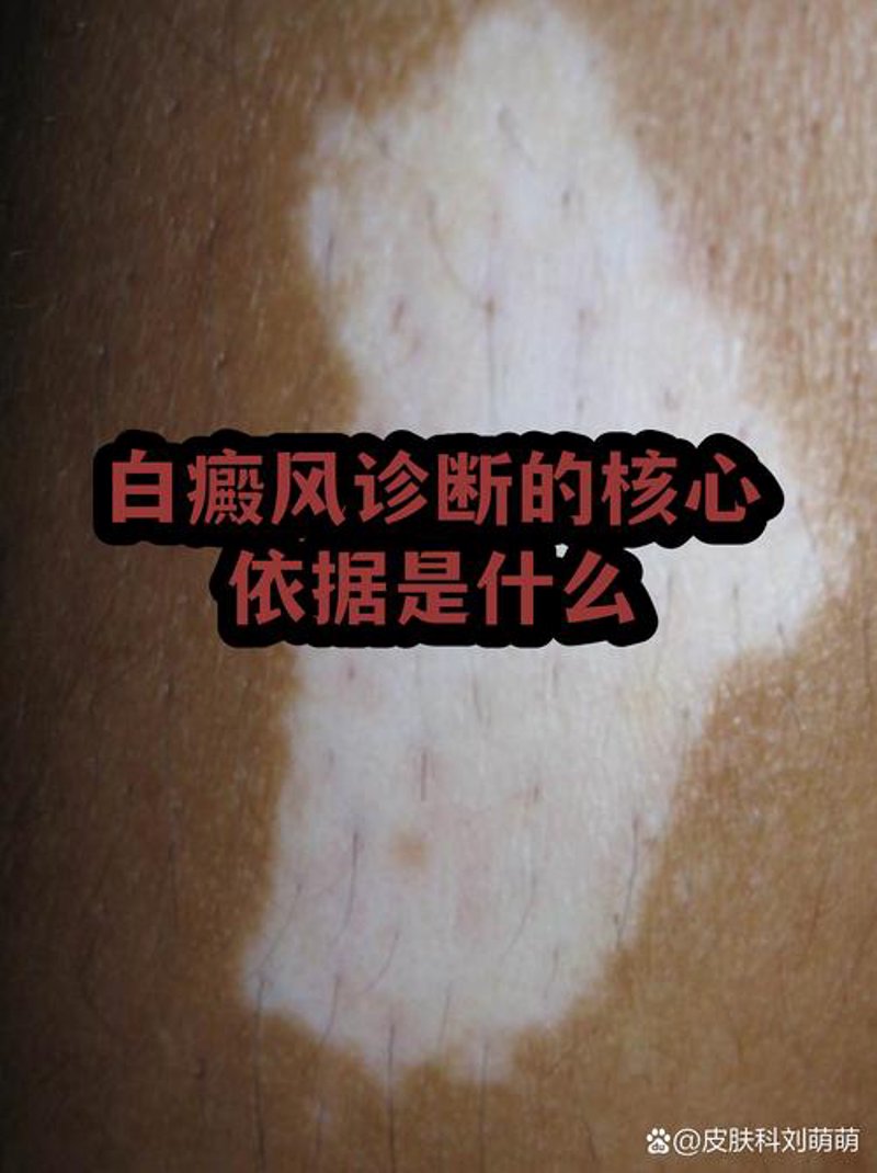 聚焦白癜风研究前沿，环亚研究院开启科学治疗新篇章
